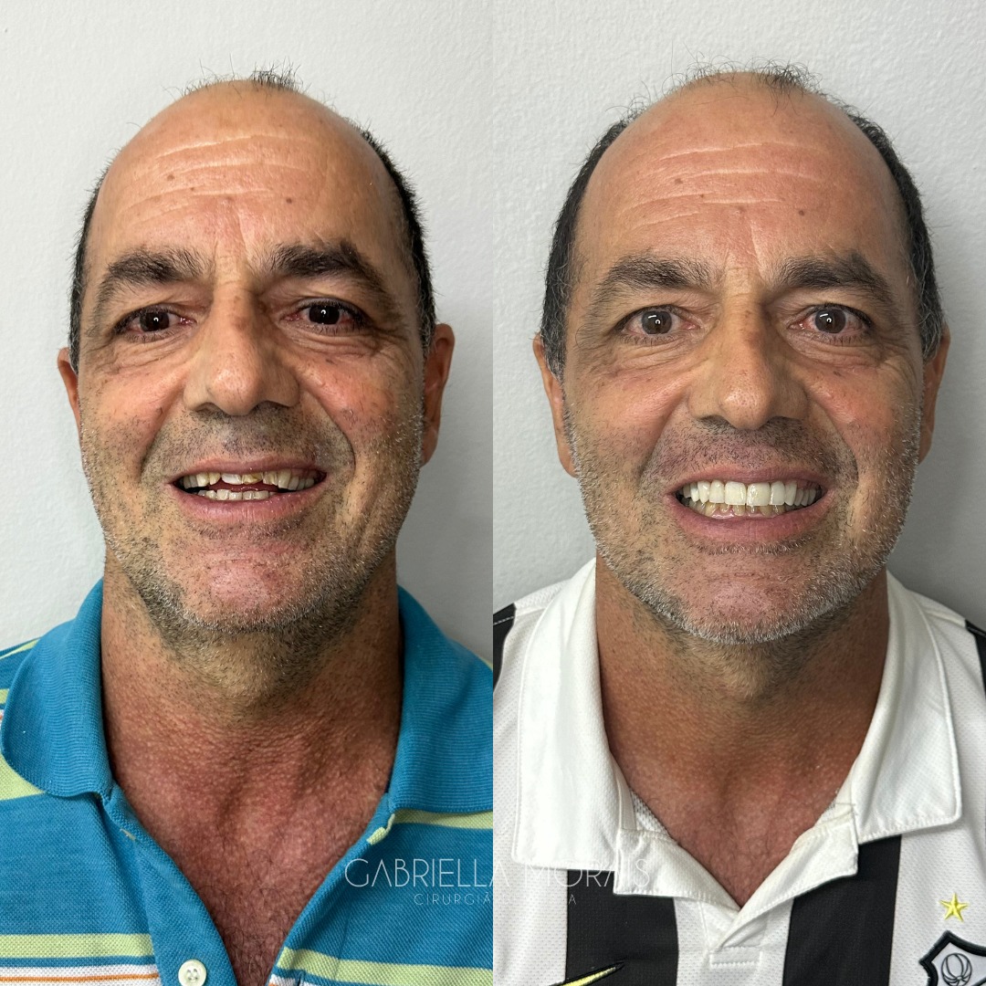 Caso 1 - Antes e Depois