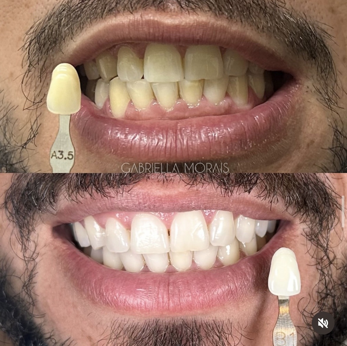Caso 10 - Antes e Depois