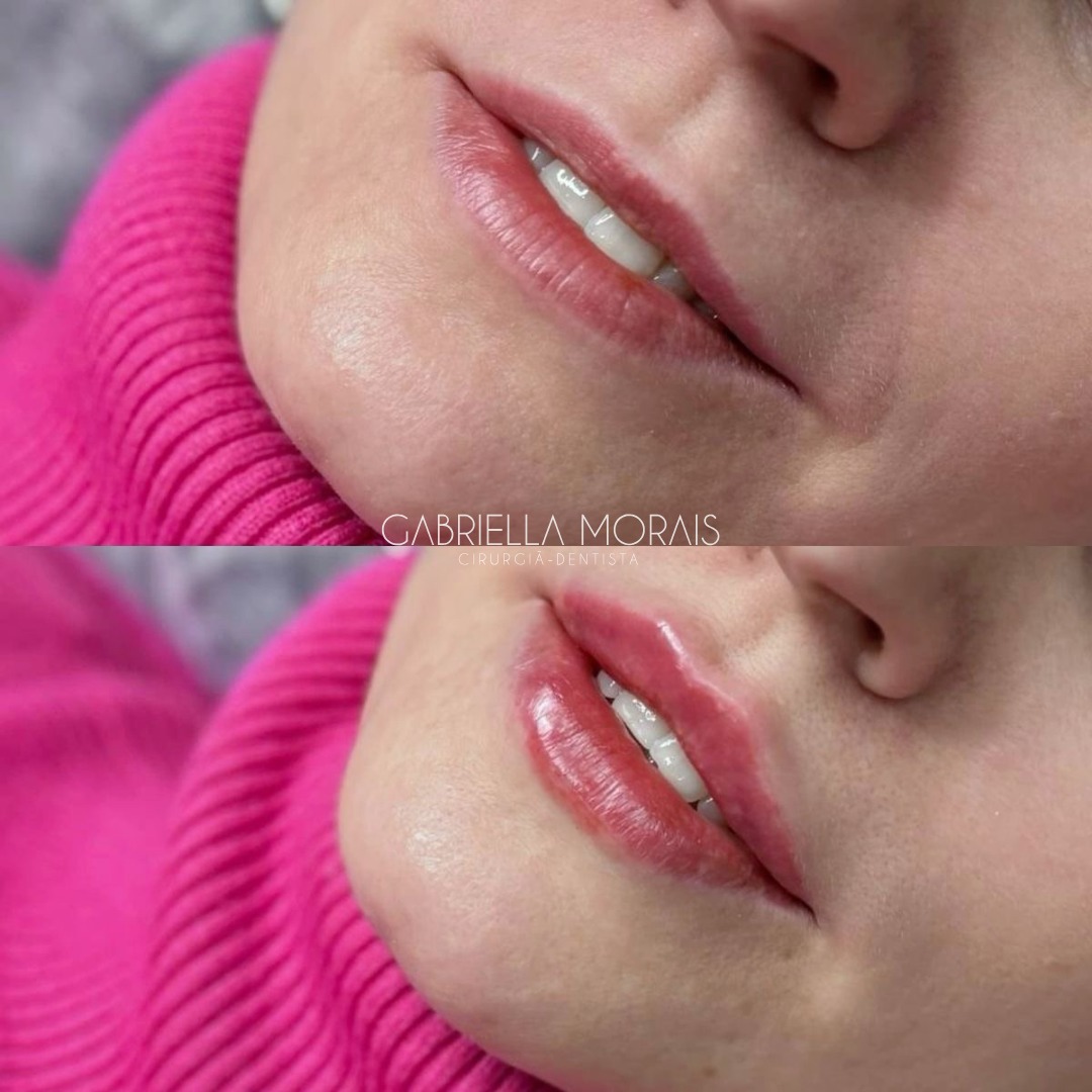 Caso 13 - Antes e Depois