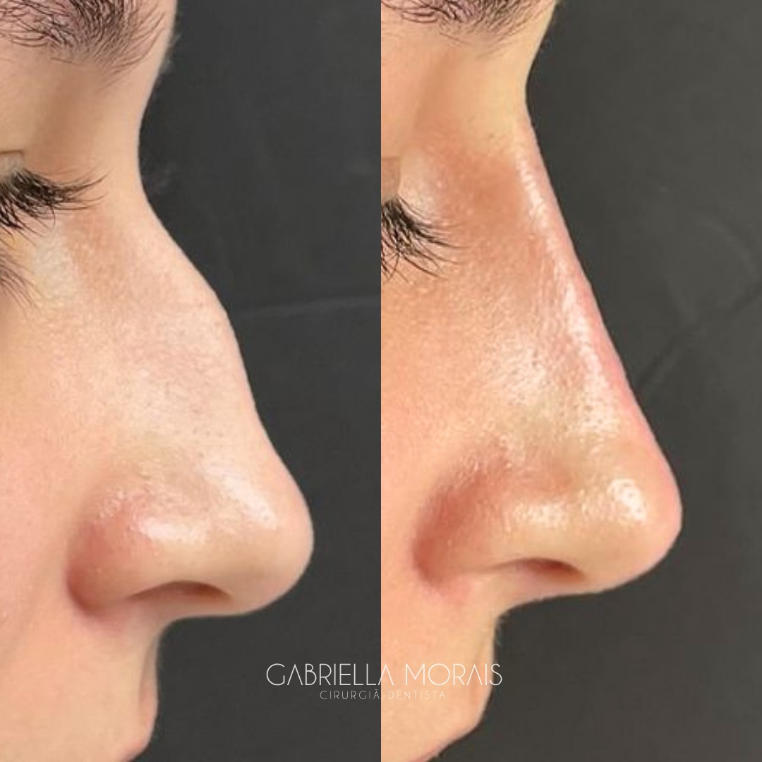 Caso 14 - Antes e Depois