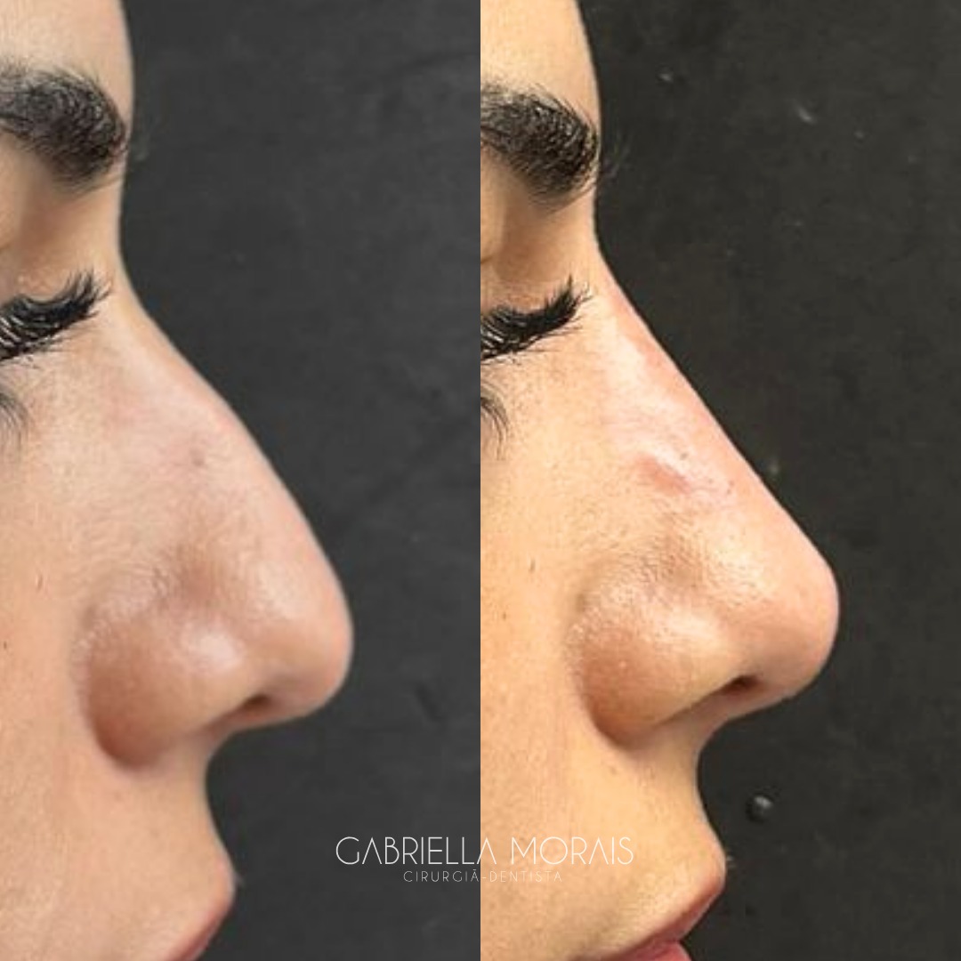 Caso 17 - Antes e Depois