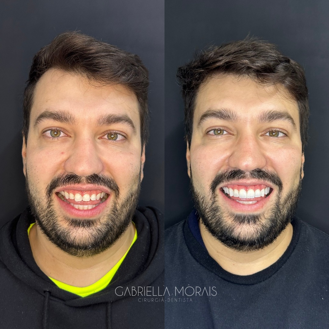 Caso 3 - Antes e Depois