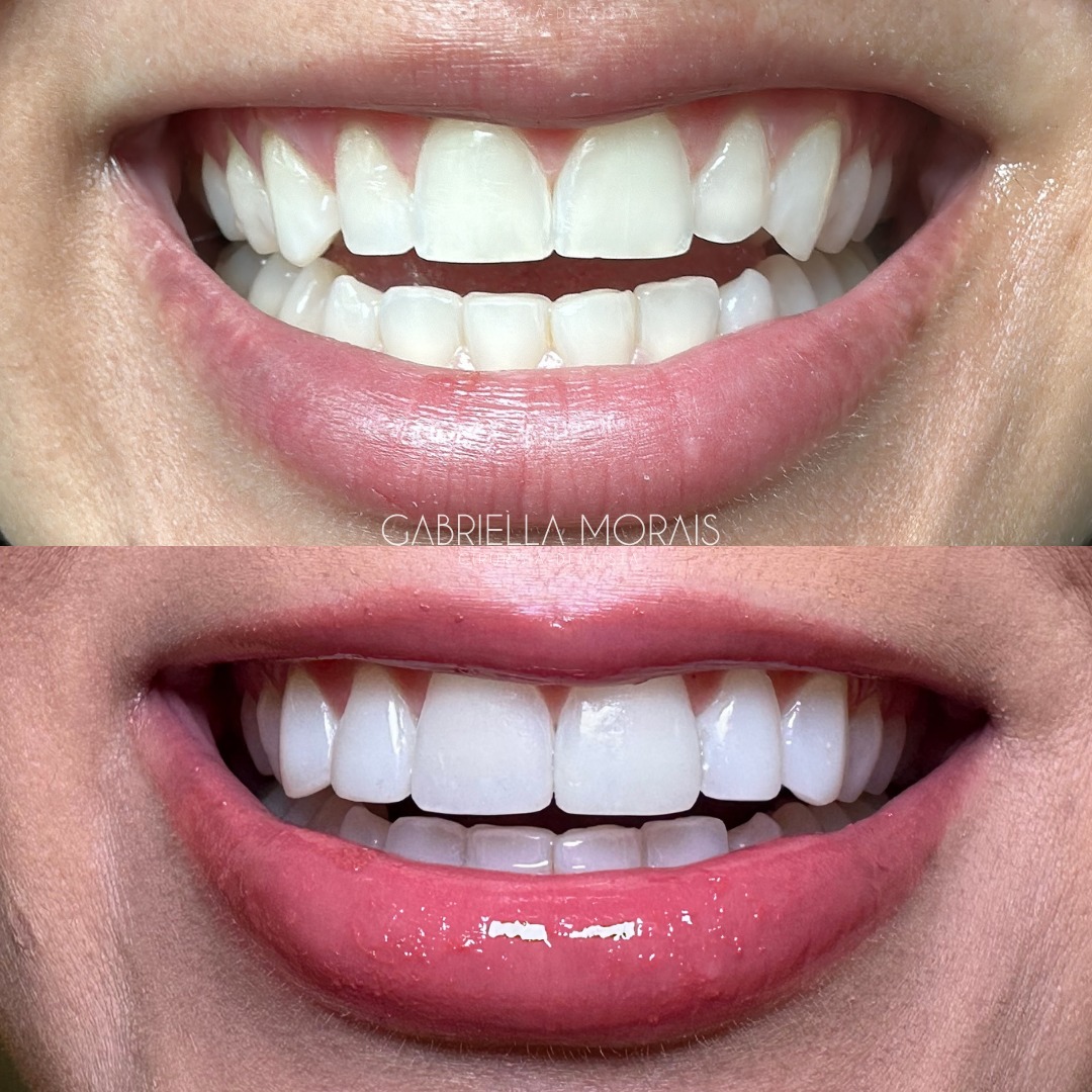 Caso 4 - Antes e Depois